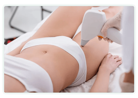 Haarentfernung Bikinizone / Intimzone für  Benningen (Neckar)